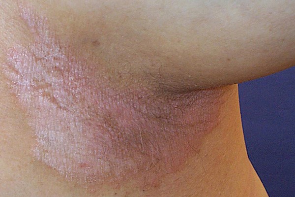 Nấm bẹn - Hình ảnh minh họa